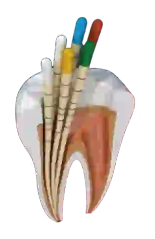 محصولات گوتا پرکا دندان‌پزشکی